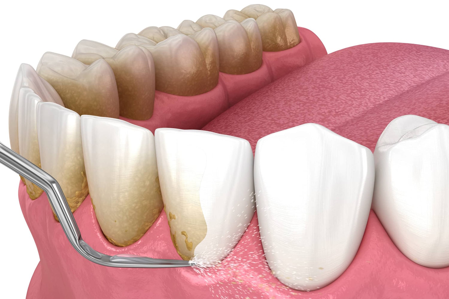 Scaling and Root Planning - CXC Dental