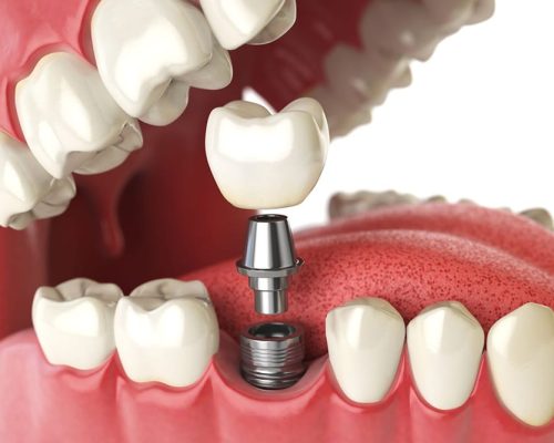 Dental-Implant-Surgery