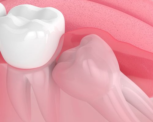 Wisdom-Tooth-Management-Extraction